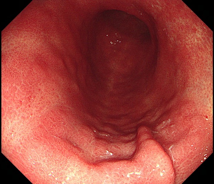 ピロリ菌陽性で胃炎がひどい人の胃