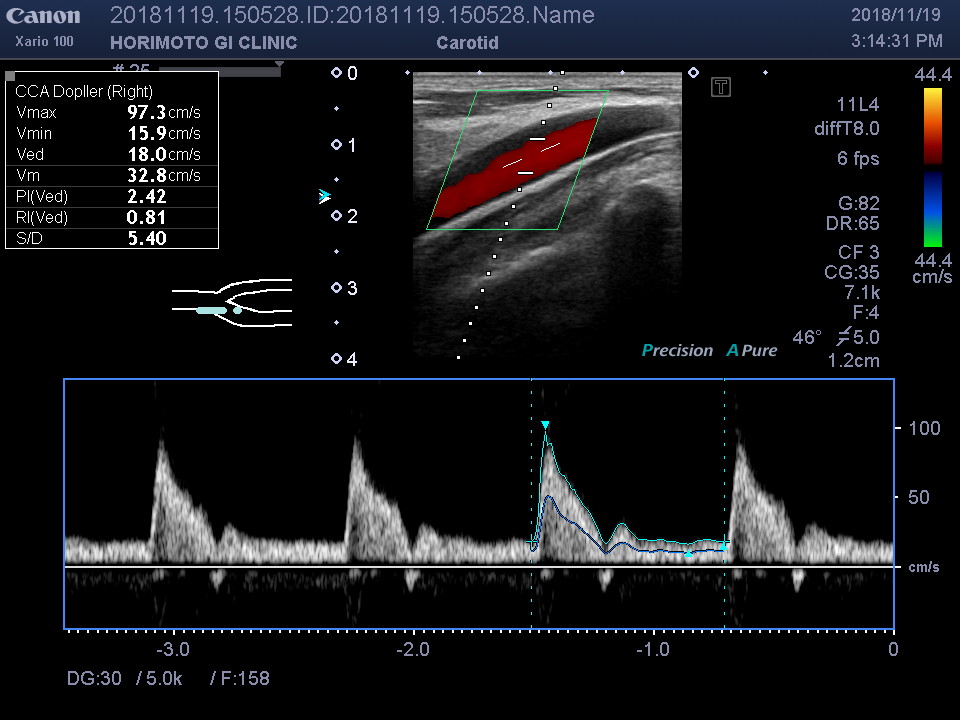 頸動脈エコー