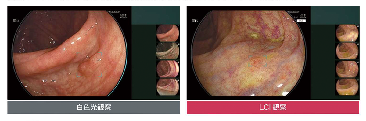 白色光観察・LCI観察
