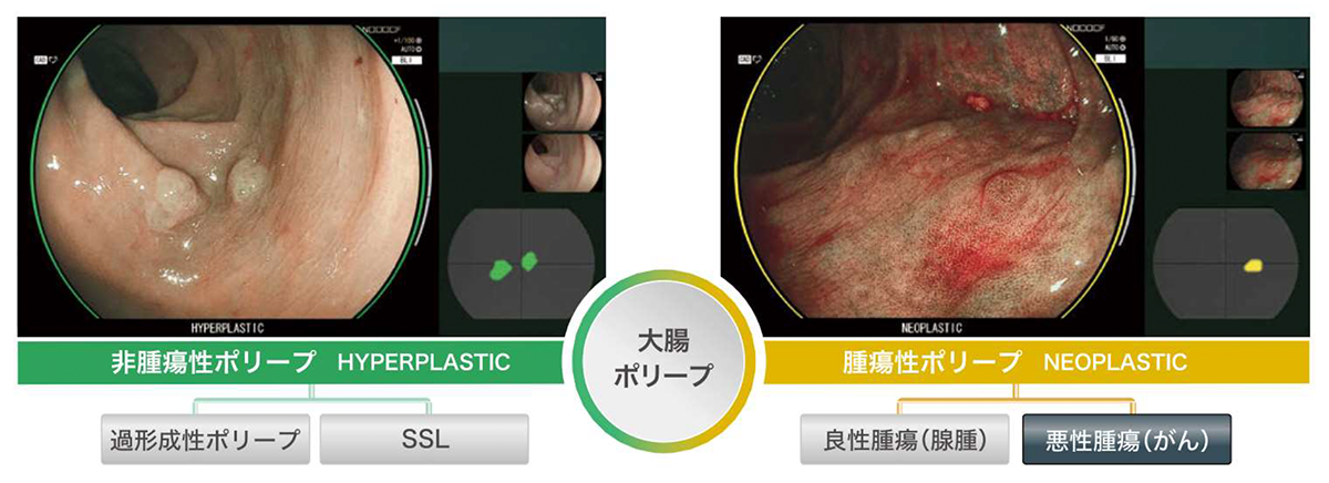 非腫瘍性ポリープ・腫瘍性ポリープ